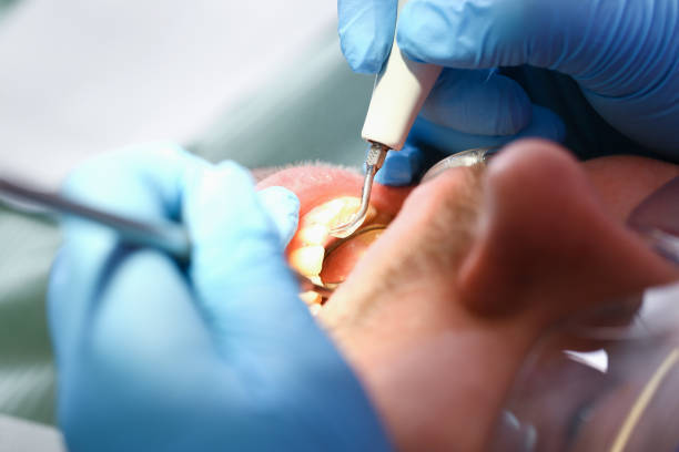 Best Knocked-Out Tooth (Avulsed Tooth) Treatment in Romney, WV